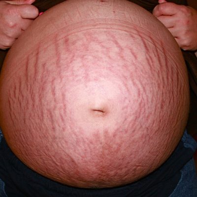 Stretch Marks